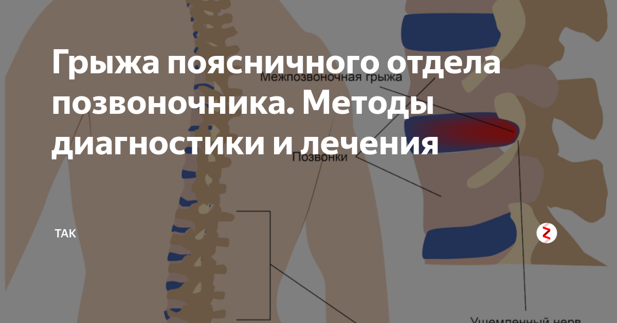 Грыжа позвоночника симптомы. Грыжа грудного отдела позвоночника. Грыжа позвоночника поясничного отдела симптомы. Межпозвоночная грыжа грудного отдела симптомы.