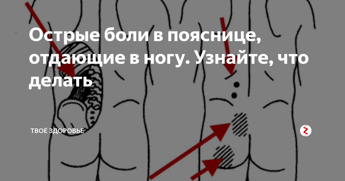 Покалывает левая нога. Локализация боли в спине. Ноющие ощущения в правой ягодице. Поясница отдает в ногу.