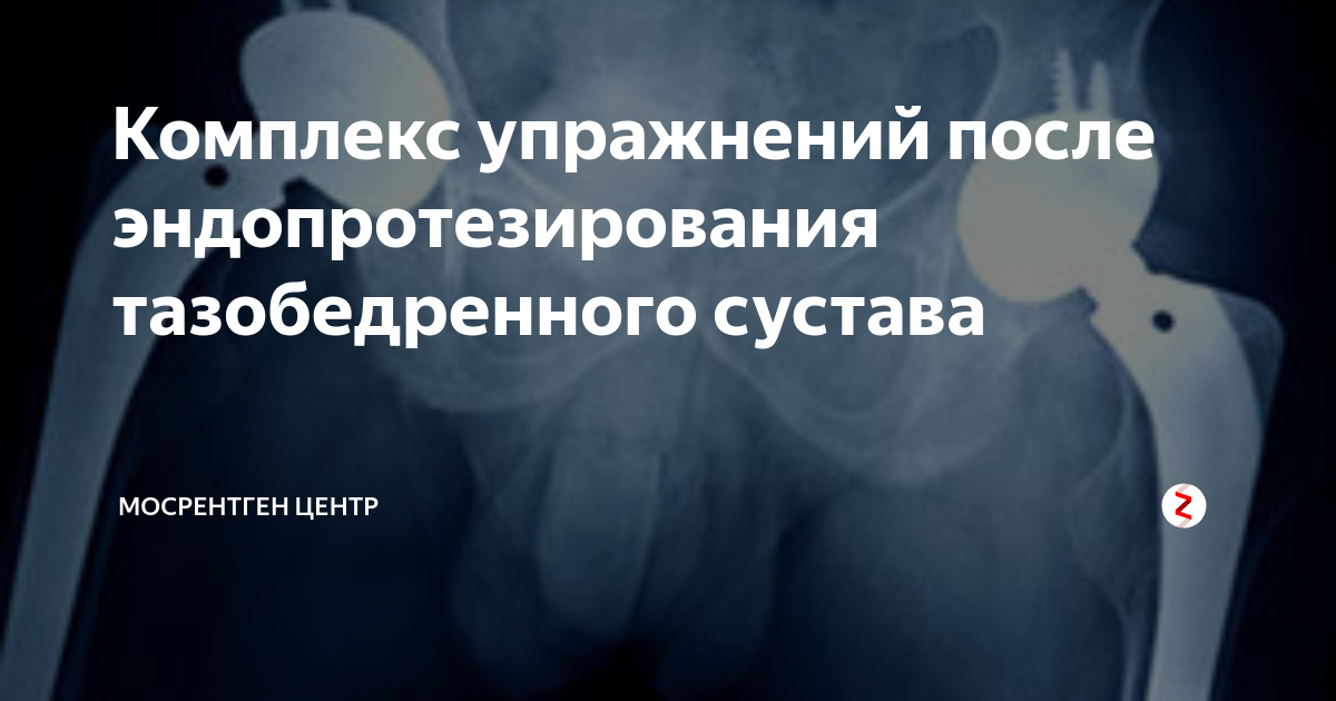 Эндопротезирование тазобедренного сустава реабилитация. Реабилитация после эндопротезирования тазобедренного сустава. Упражнения после эндопротезирования тазобедренного сустава. Операция по эндопротезированию тазобедренного сустава. Осложнения после эндопротезирования тазобедренного сустава