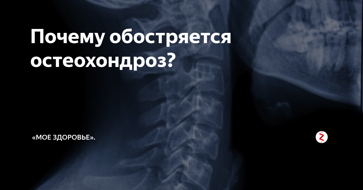 Может ли обостриться остеохондроз. Обострение остеохондроза. Обострение шейного остеохондроза. Остеохондроз причины. Обострение остеохондроза симптомы.