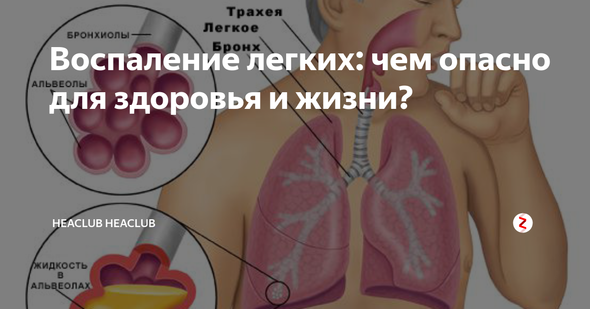 Что такое пневмония и чем она опасна. Что такое воспаления легких это опасно. Воспаление лёгких это опасно.