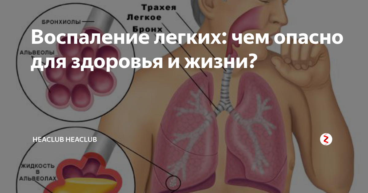 Чем опасна пневмония. Что такое воспаления легких это опасно. Воспаление лёгких это опасно.