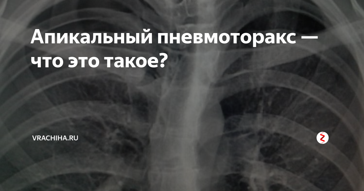 Пневмоторакс (pneumothorax) у кошек: лечение