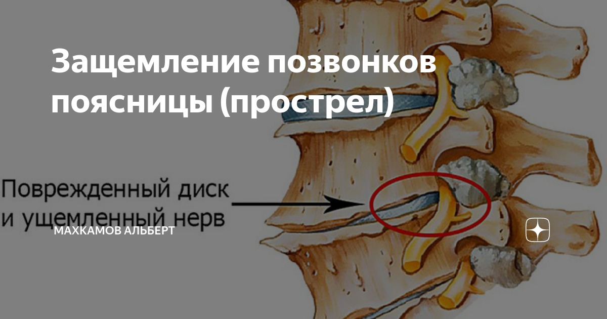 Защемление поясничного отдела лечение Защемление поясничного отдела лечение