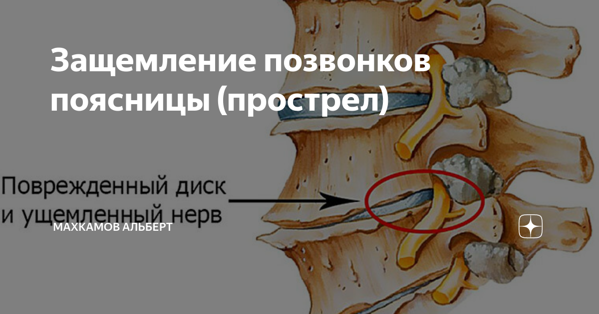 Защемление нерва грыжей в пояснице