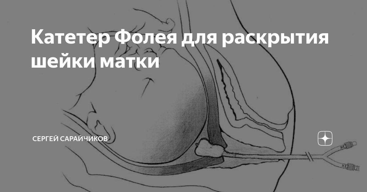 Стимулировать матку. Подготовка шейки катетером Фолея. Катетер для раскрытия шейки матки перед родами фолеч. Катетер Фолея для стимуляции родов. Катетер Фолея для стимуляции шейки матки перед родами.