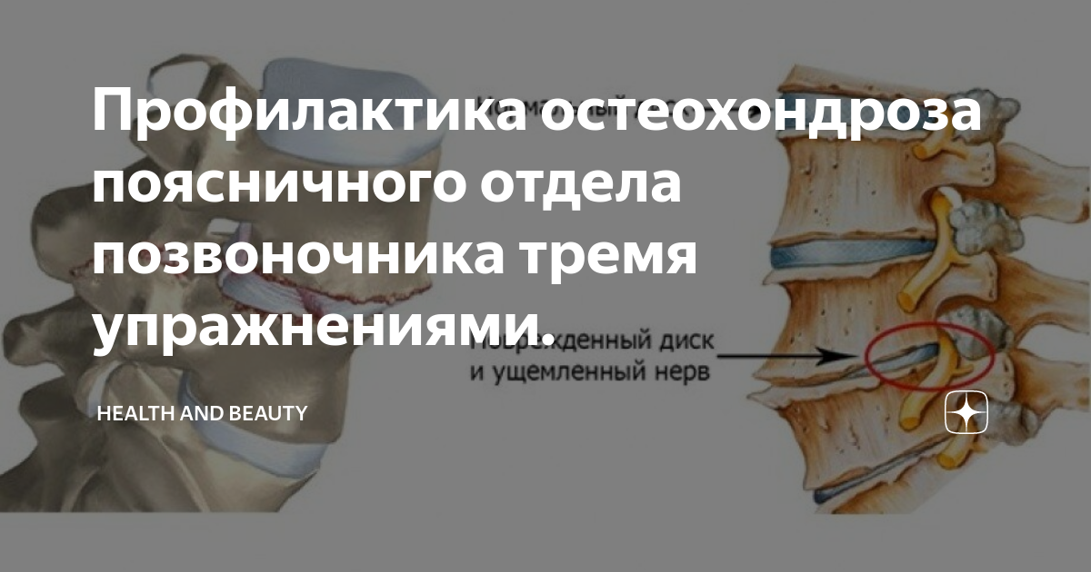 Мкб остеохондроз шейного отдела позвоночника у взрослых