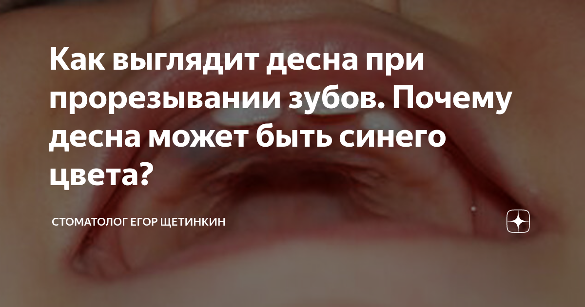 Как выглядят десна в 3 месяца