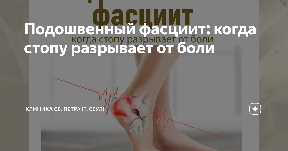 Подошвенный фасциит: когда стопу разрывает от боли | Клиника св. Петра ...