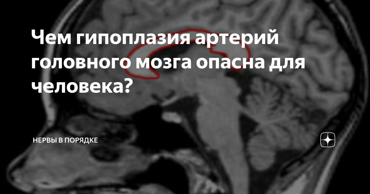 Гипоплазия сегмента. Гипоплазия позвоночной артерии. Гипоплазия сосудов головного мозга. Гипоплазия правой позвоночной артерии сегменты. Гипоплазия артерии головного мозга.