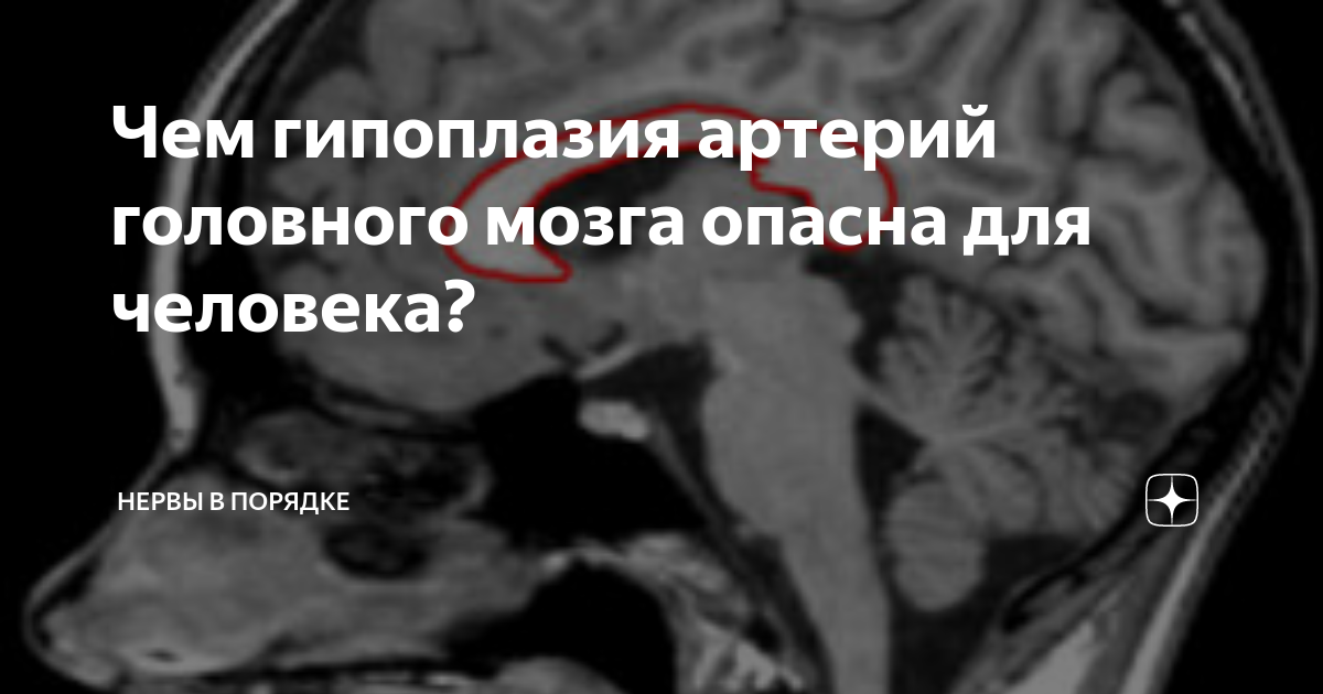 Гипоплазия правой позвоночной артерии симптомы. Гипоплазия v4 позвоночной артерии. Гипоплазия правой позвоночной артерии сегменты. Гипоплазия артерии мозга. Гипоплазия левой позвоночной артерии.