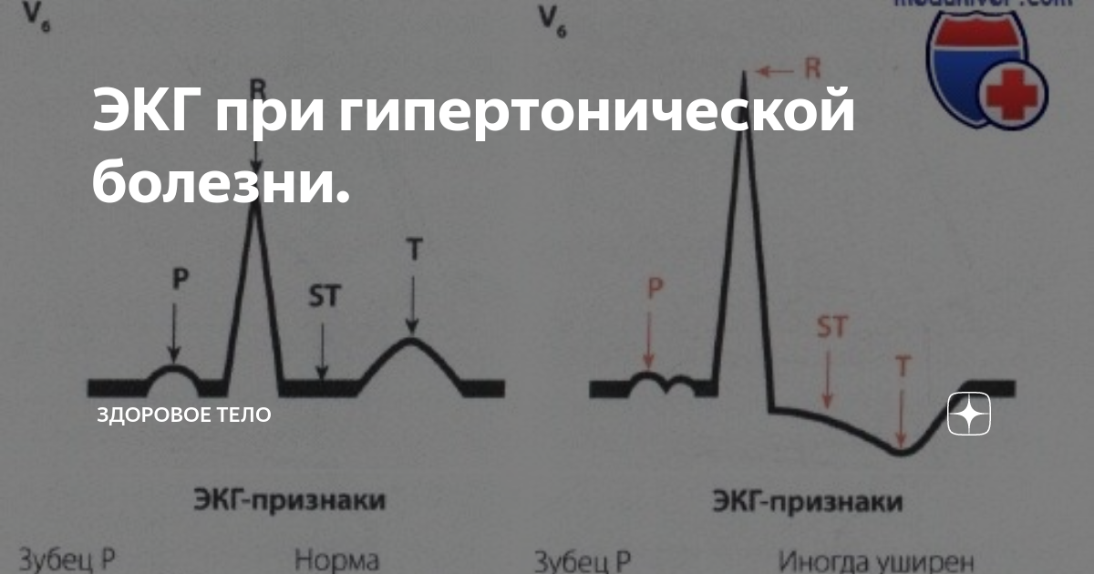 ЭКГ в 12 отведениях