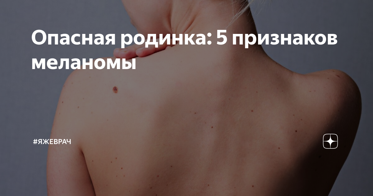 Архангельская городская клиническая больница № 6 Что нужно знать о меланоме