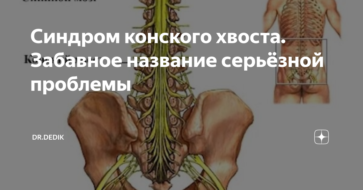 Синдром конского хвоста. Забавное название серьёзной проблемы | Dr ...