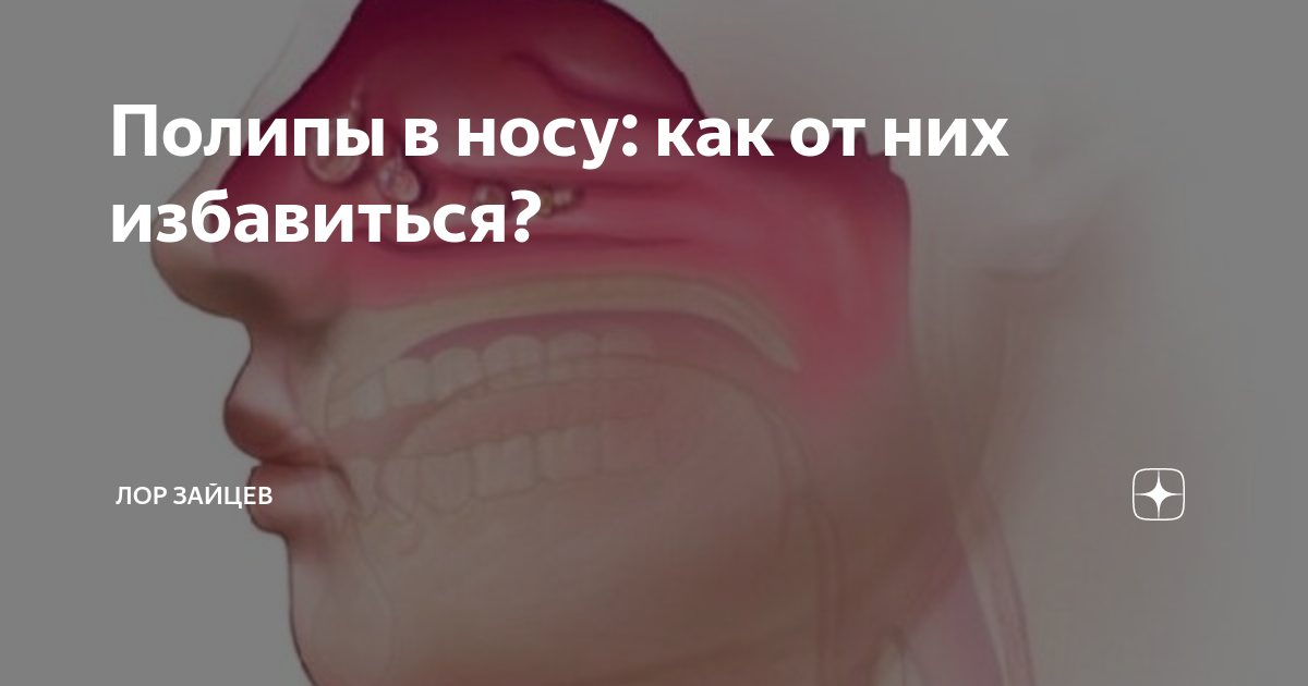 полипы в носу