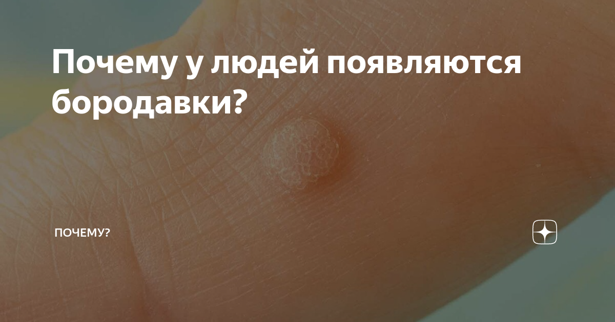 Почему у людей появляются бородавки? | Почему? | Дзен