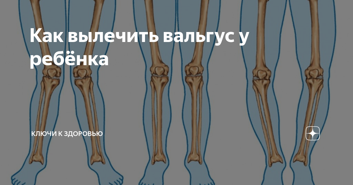 Вальгус мкб москва. Вальгус коленных суставов. Динамический вальгус колена. Варус вальгус коленей скелет сколиоз.