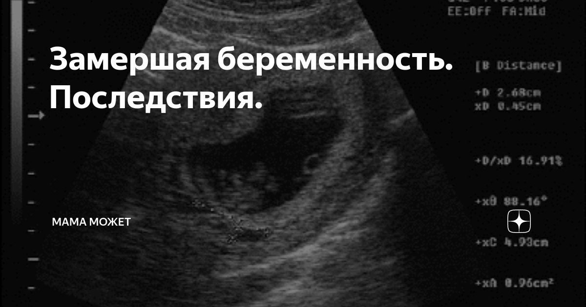 Замершая беременность форум. Вымершая беременности. Замершая беременность УЗИ. Замершая беременность на раннем сроке.