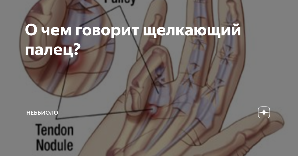 Щелкающий палец лечение народными средствами