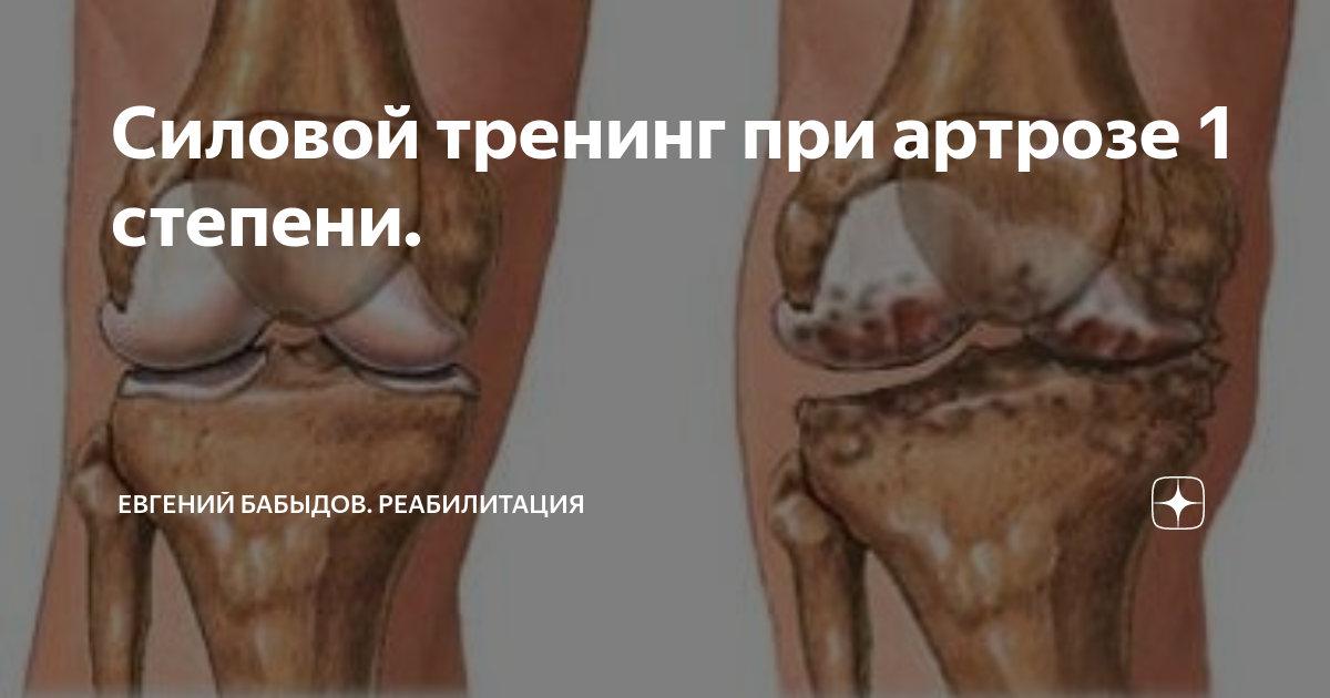 Важность физической активности при артрозе и артрите