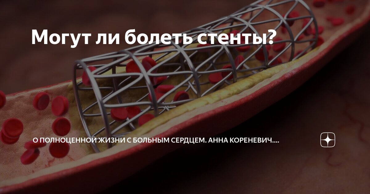 сколько длится больничный после инфаркта и стентирования