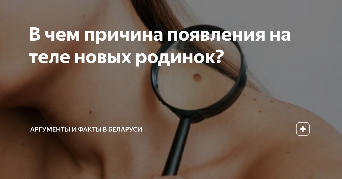 В чем причина появления на теле новых родинок? | Аргументы и факты в ...