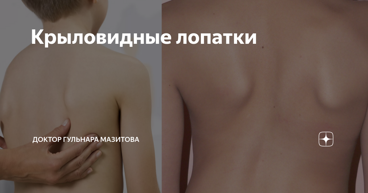 Крыловидные лопатки: найдено 80 изображений