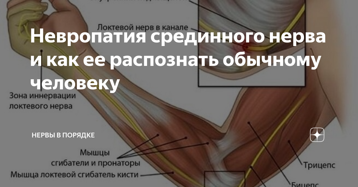 Левый локтевой нерв. Невропатия локтевого нерва. Чувствительные расстройства локтевого нерва. Кисть при нейропатии срединного нерва. Неврит (невропатия) локтевого нерва..