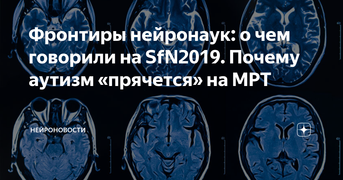 Мрт при аутизме. Мрт аутистов. Мозг аутиста на мрт. Можно ли по мрт определить аутизм. Виден ли на мрт аутизм.