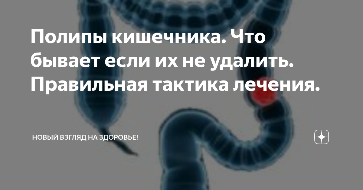 Полип лечить народными средствами. Полипы в толстом кишечнике. Полипы в кишечнике симптомы