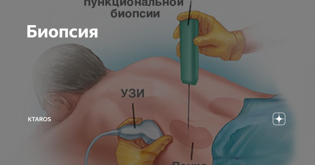 Как берут биопсию