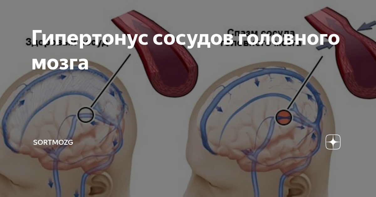 5 простых способов укрепить сосуды