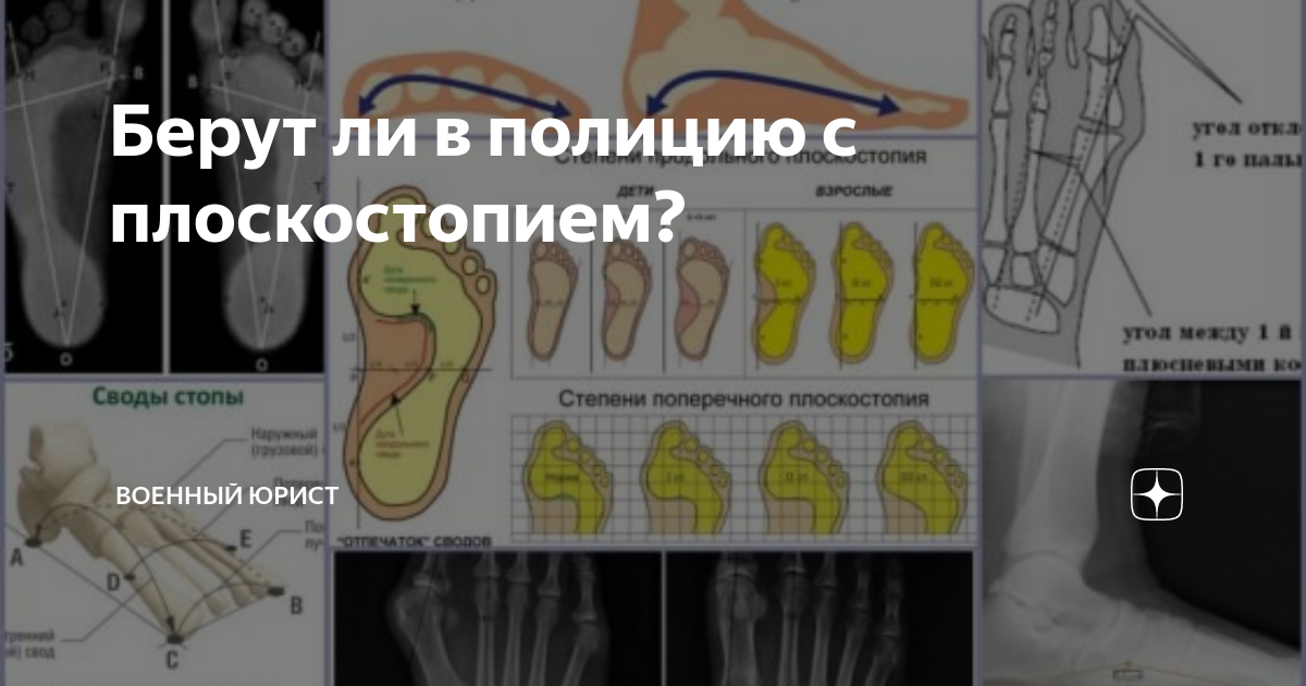 Берут ли в полицию с плоскостопием? | Военный юрист | Дзен
