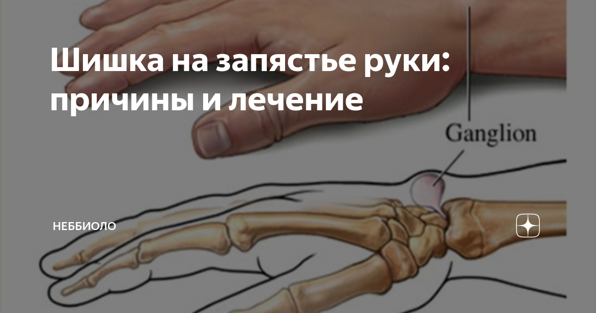 болит запястье руки на сгибе
