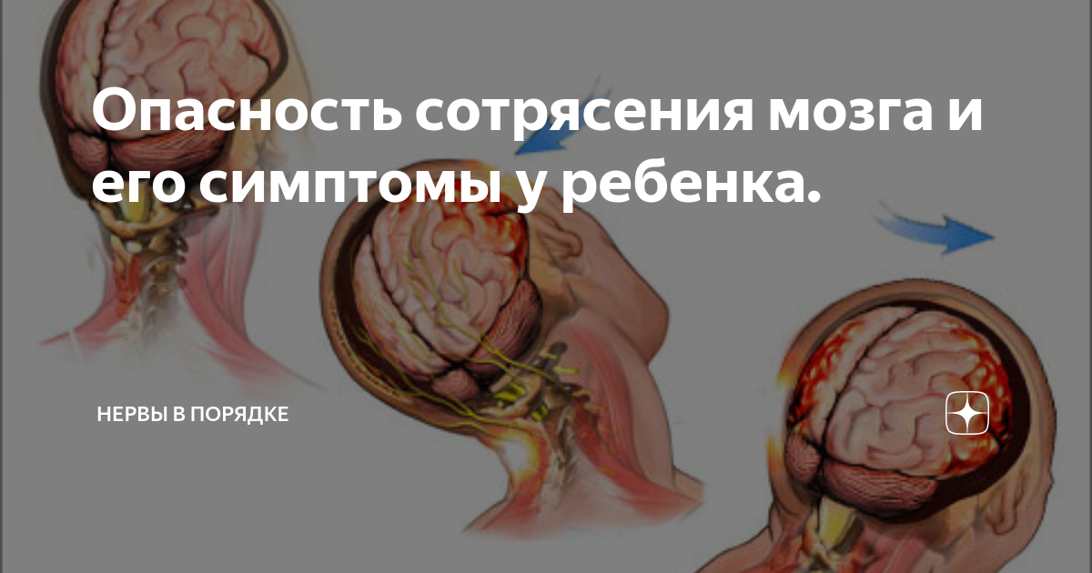 Лечение сотрясения головного мозга. Виды и симптомы | Медицинский центр НЭО в Казани