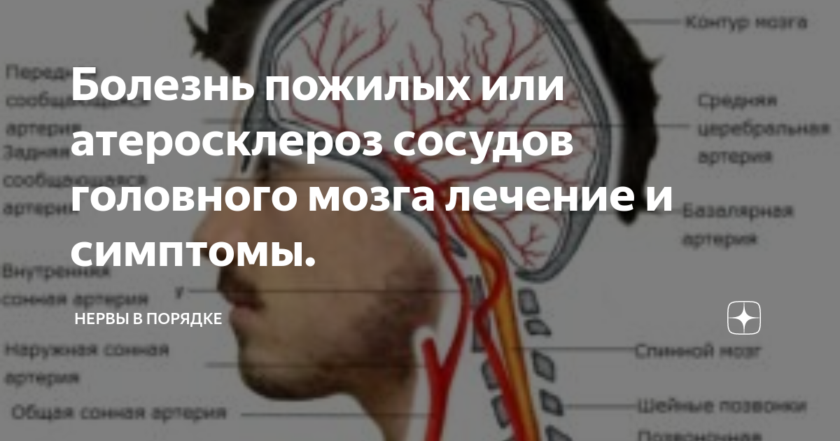 Сужение сосудов симптомы лечение. Атеросклероз сосудов головного мозга. Проявления атеросклероза артерий головного мозга. Атеросклеротические поражения артерий головного мозга. Атеросклероз сосудов головного мозга симптомы.