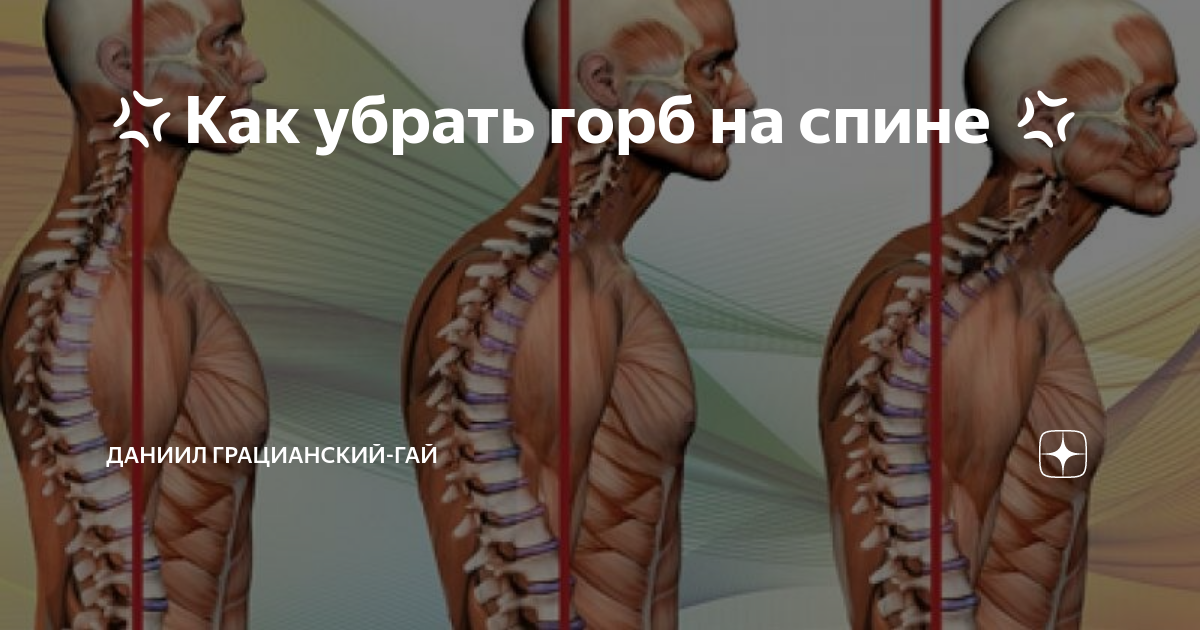 Как убрать горб на спине упражнения
