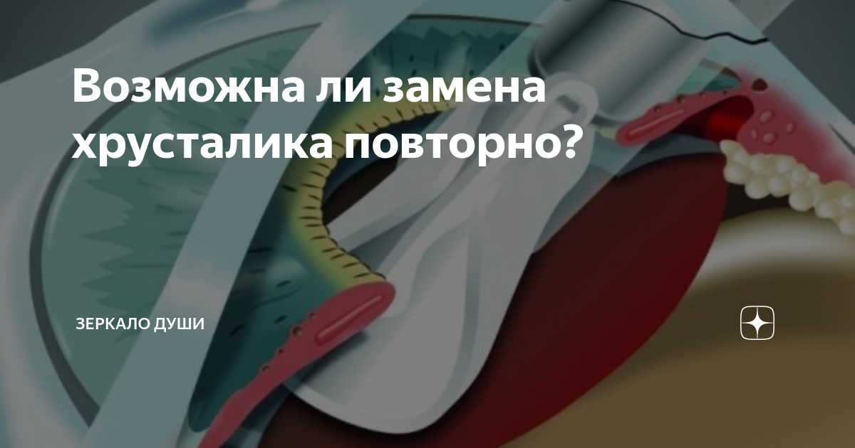 Возможна ли повторная. Заменяют ли повторно хрусталик. Замена хрусталика повторно возможна ли. Меняют ли хрусталики повторно. Можно ли заменить искусственный хрусталик.