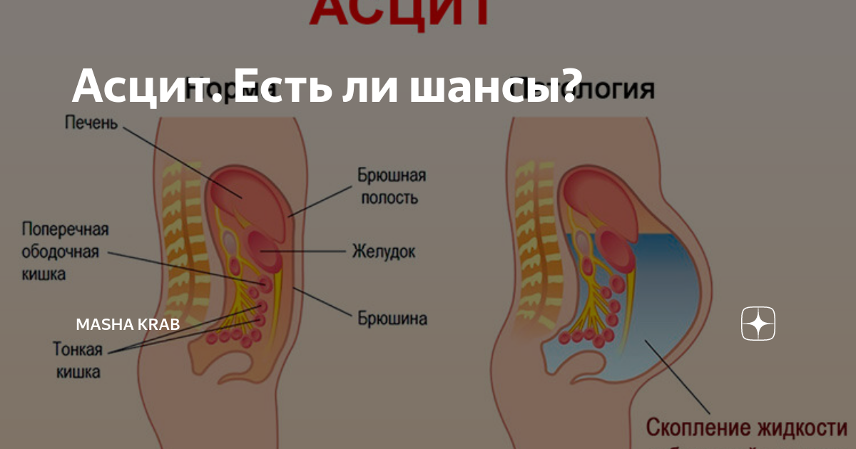 Скопление жидкости при онкологии