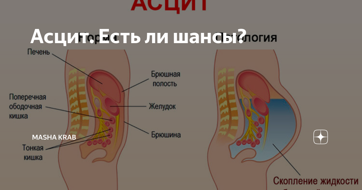 Скапливается жидкость