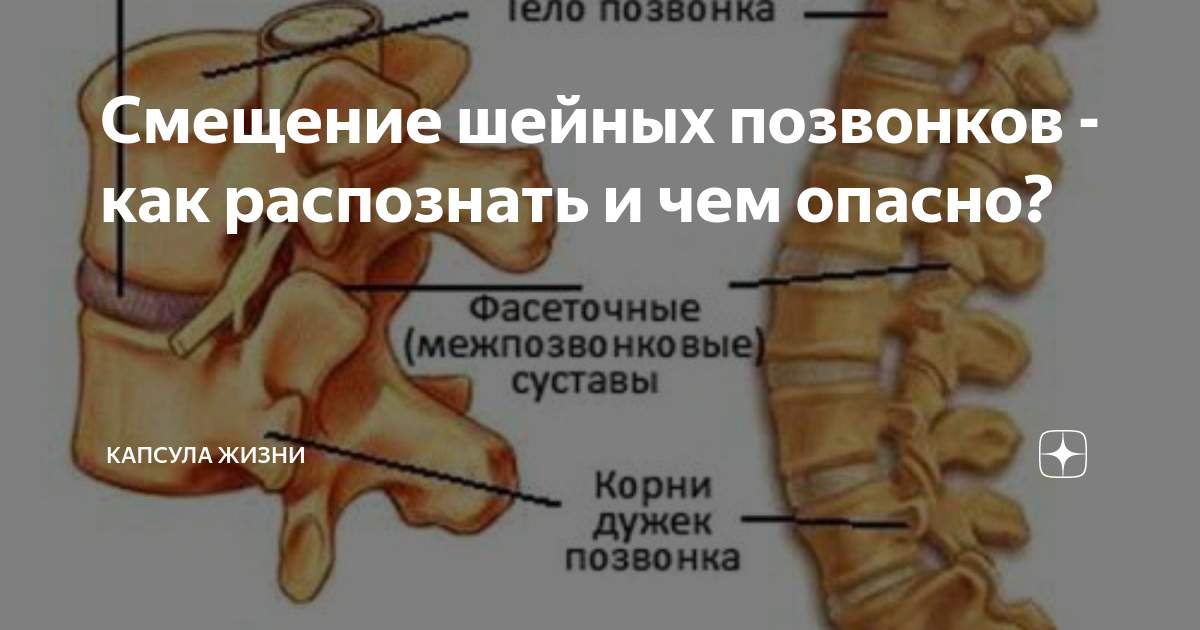 Смещение поясничных позвонков Смещение поясничных позвонков