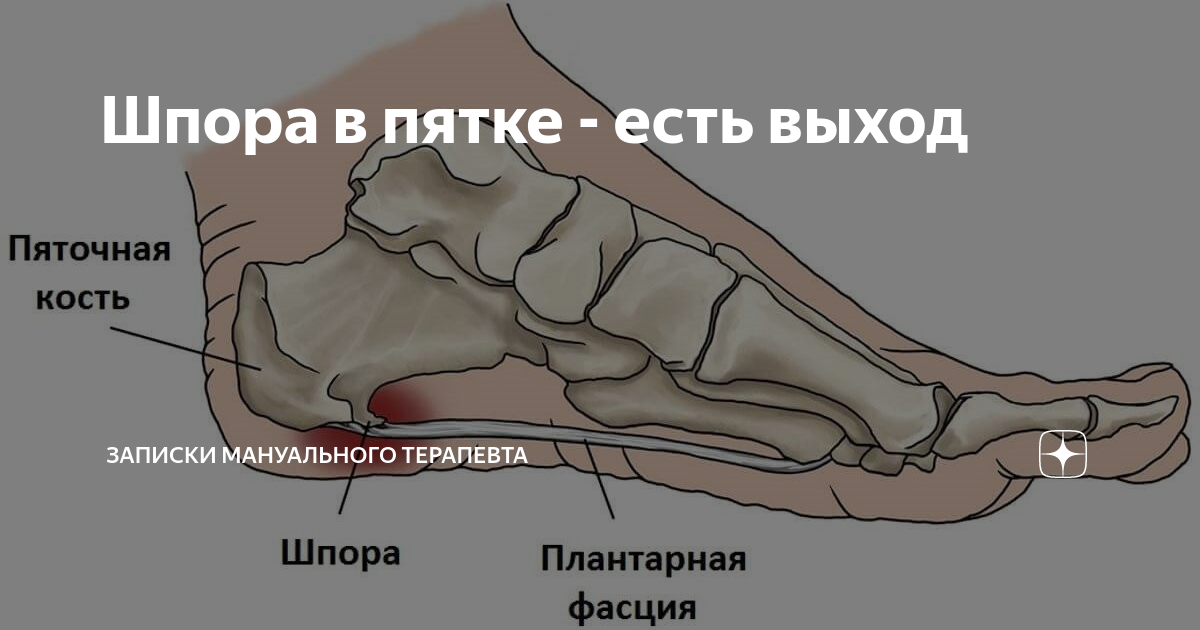 Пяточная шпора плантаный фасциит