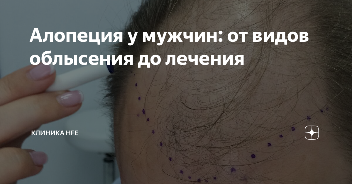 Алопеция у мужчин: от видов облысения до лечения | Клиника HFE | Дзен