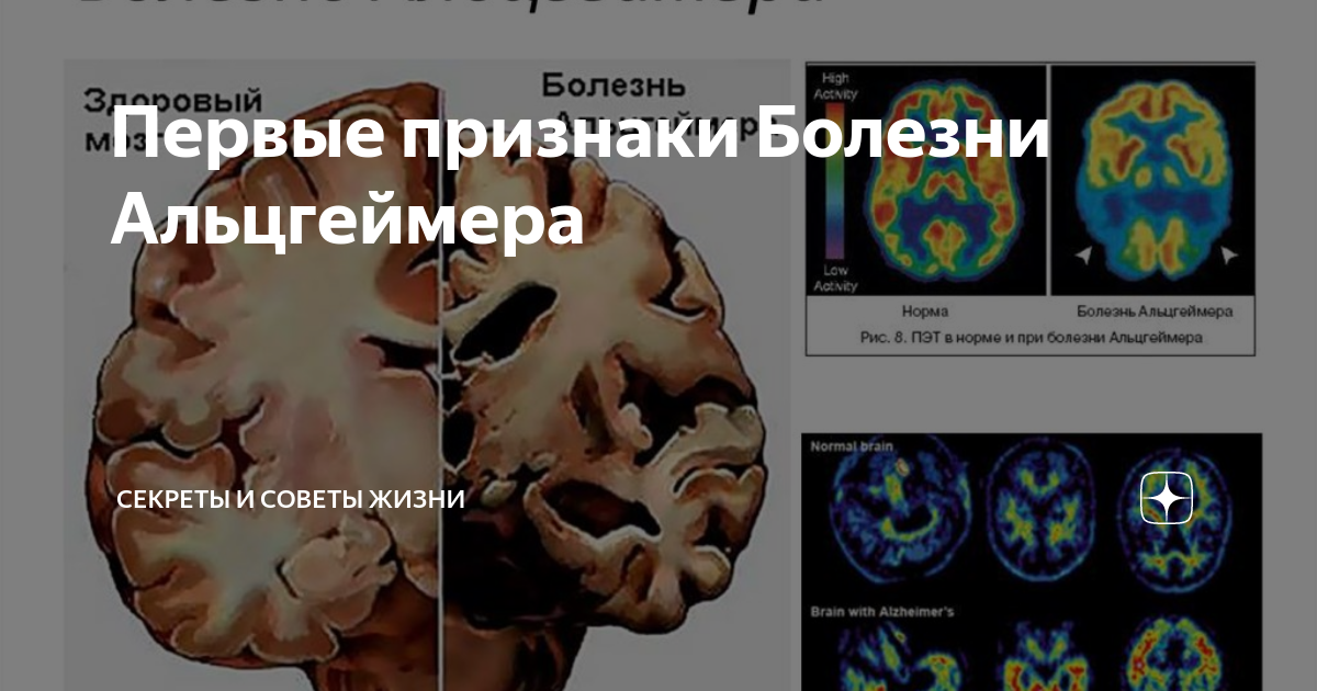 Передается ли альцгеймер по наследству