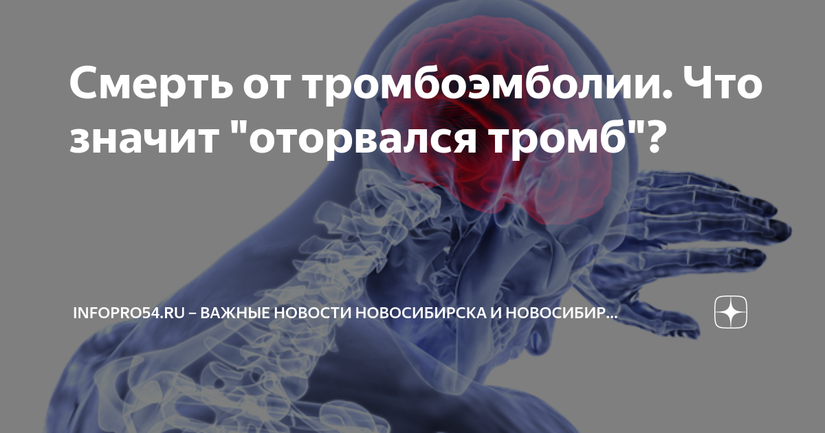 Смерть от тромбоэмболии. Что значит "оторвался тромб"? | Infopro54.ru ...