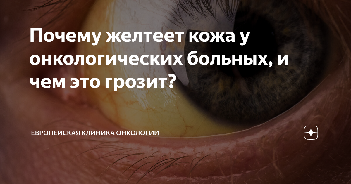 Почему желтеет кожа у онкологических больных, и чем это грозит? | Сеть ...