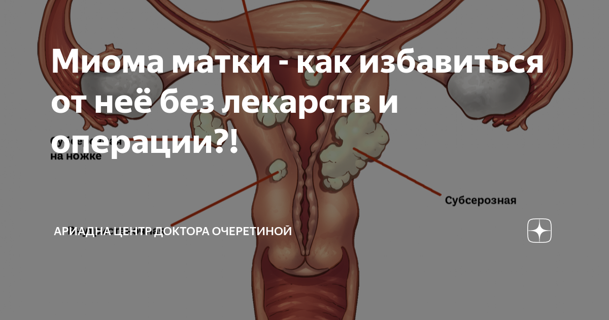 Миома матки - как избавиться от неё без лекарств и операции?! | Ариадна ...