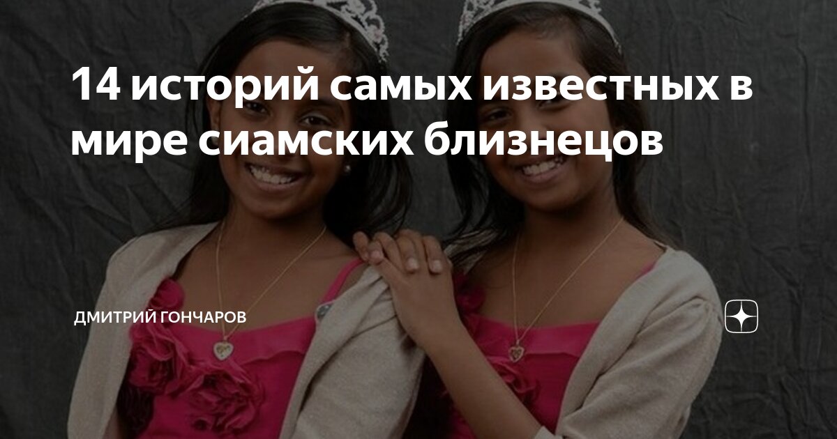 14 историй самых известных в мире сиамских близнецов | ПРАВДИВАЯ ...