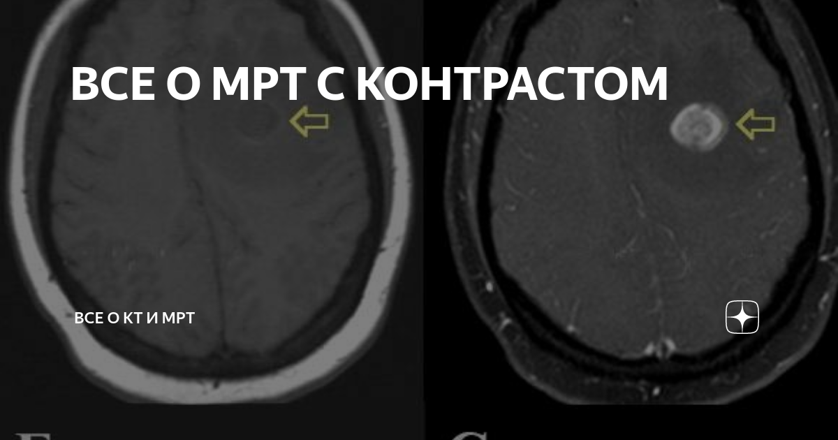 Контраст перед мрт