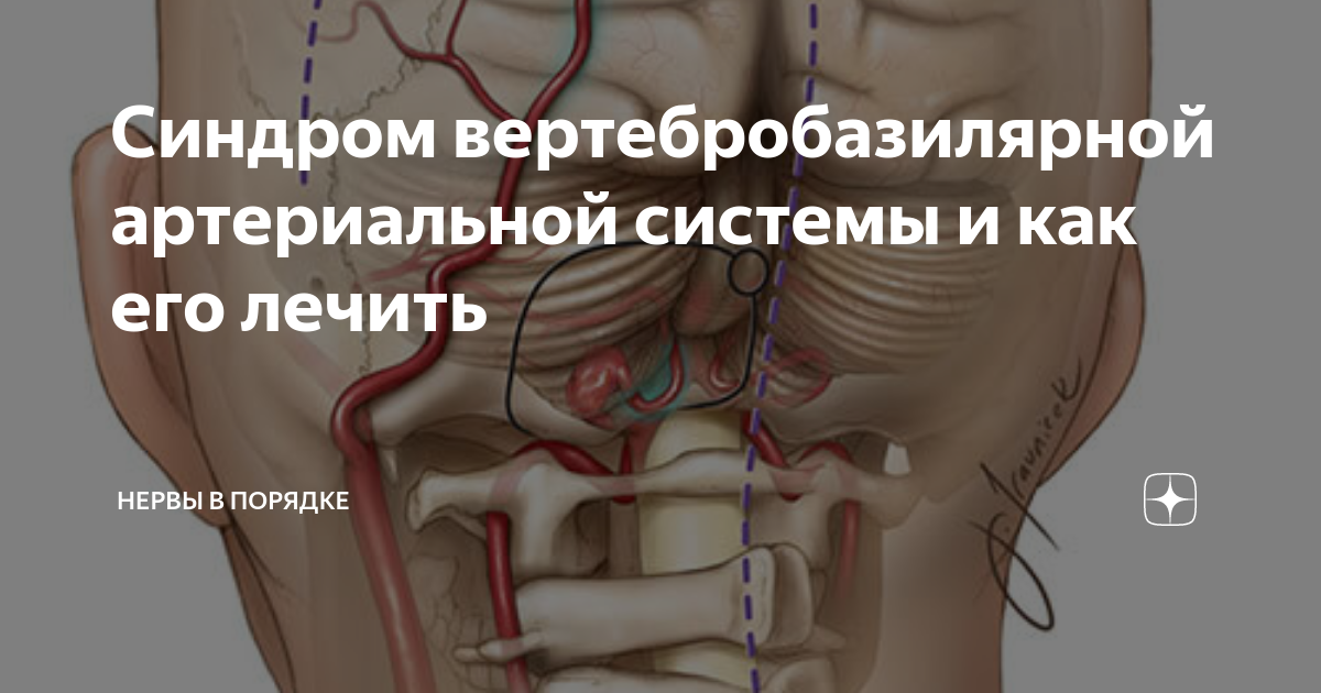 Синдром вертебробазилярной системы